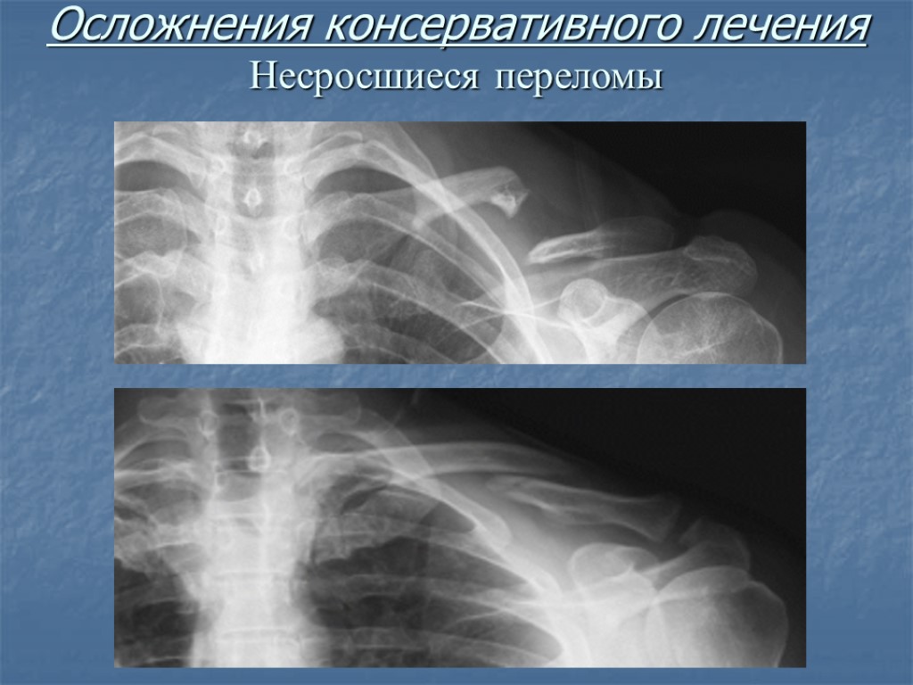 Осложнения консервативного лечения Несросшиеся переломы